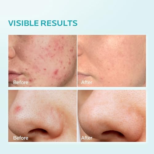 Azelaic Acid Facial Cream 10% - Pimple Relief & Skin Clarifying Serum with AHA, 1 Oz