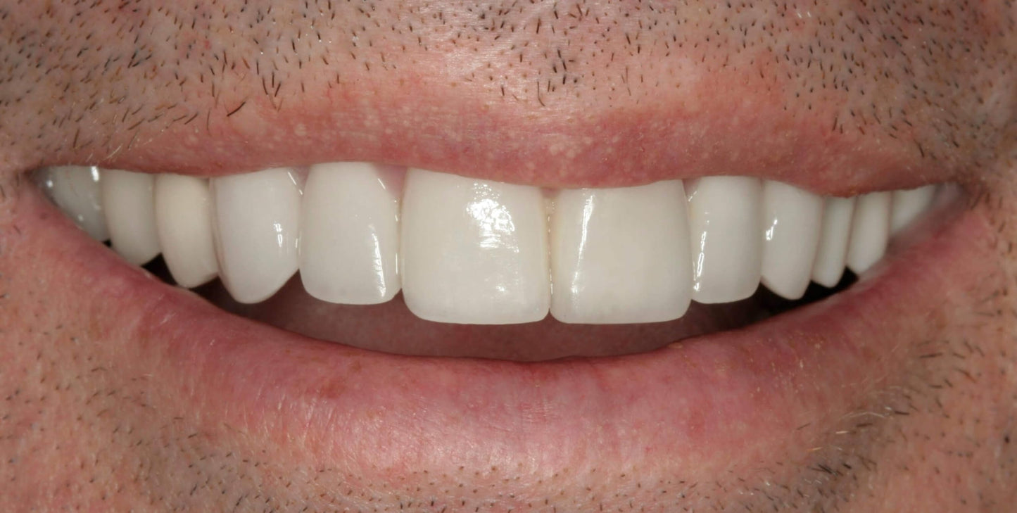 Jesse Dent - DIY Dentures, Customizable Kit with 12 Pieces, Simple to Use. Dentures Upper and Lower, Home Denture Solution for an Ideal Smile, Women and Men