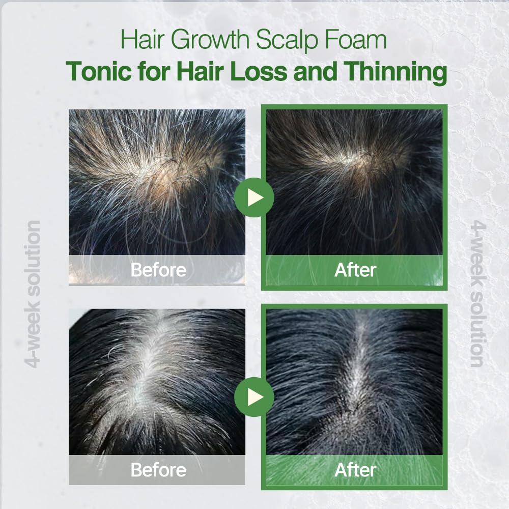 Rootonix Rosemary Scalp leave‑in Tonic – Sparkling Nutrient Foam with Rosemary, Biotin, Caffeine - Hair Growth Serum - 3.38 fl. oz. (100ml)