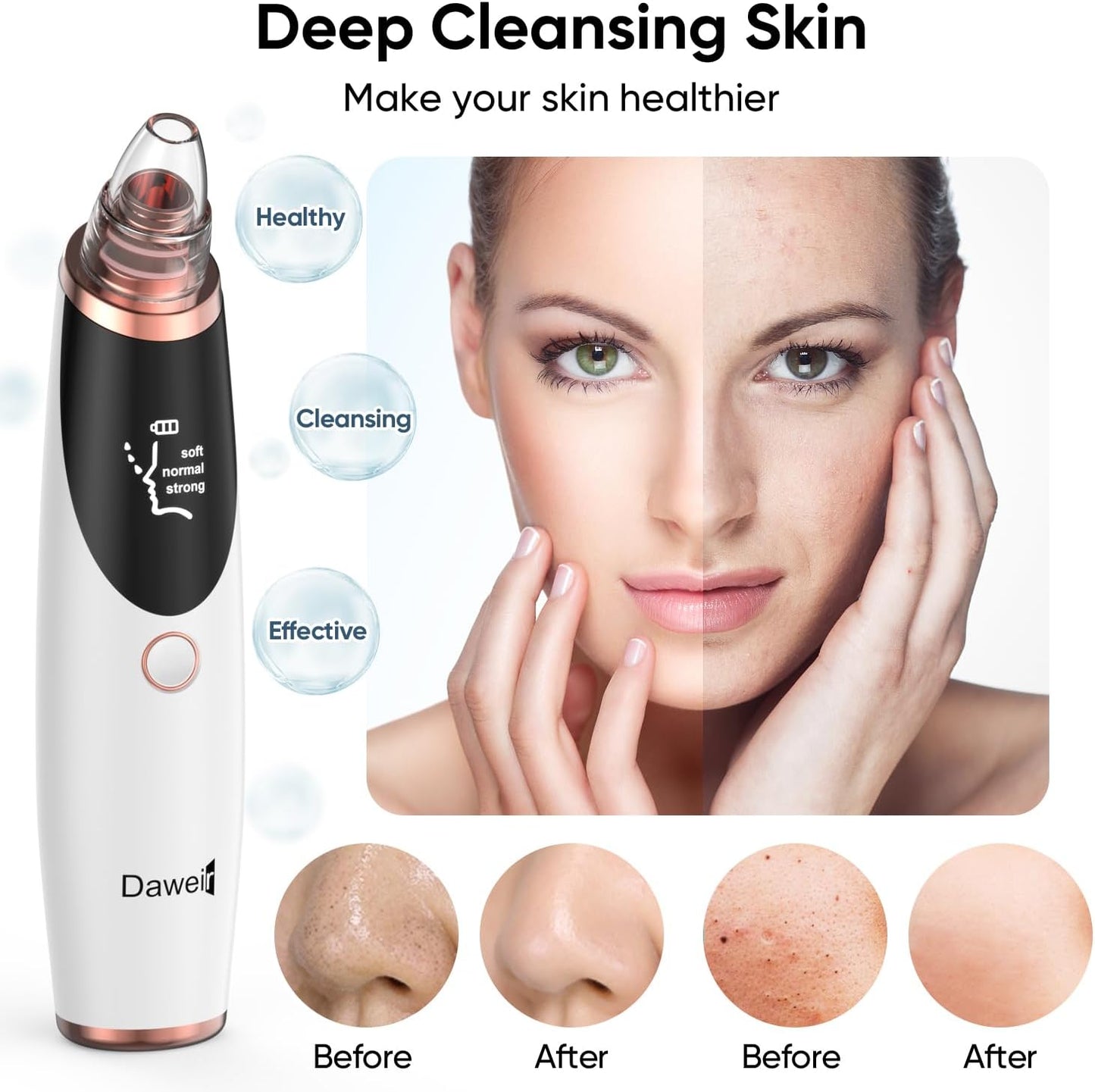 Deep Cleansing Blackhead Remover Vacuum – USB Rechargeable Pore Cleaner with 3 Suction Levels & 5 Tips