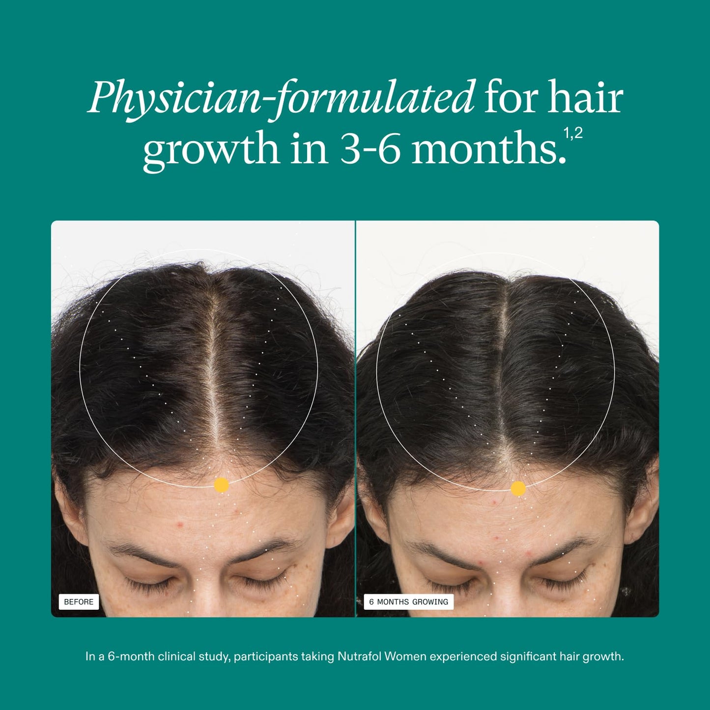 Nutrafol Women's Hair Growth Supplements, Ages 18-44, Clinically Proven for Visibly Thicker and Stronger Hair, Dermatologist Recommended - 1 Month Supply