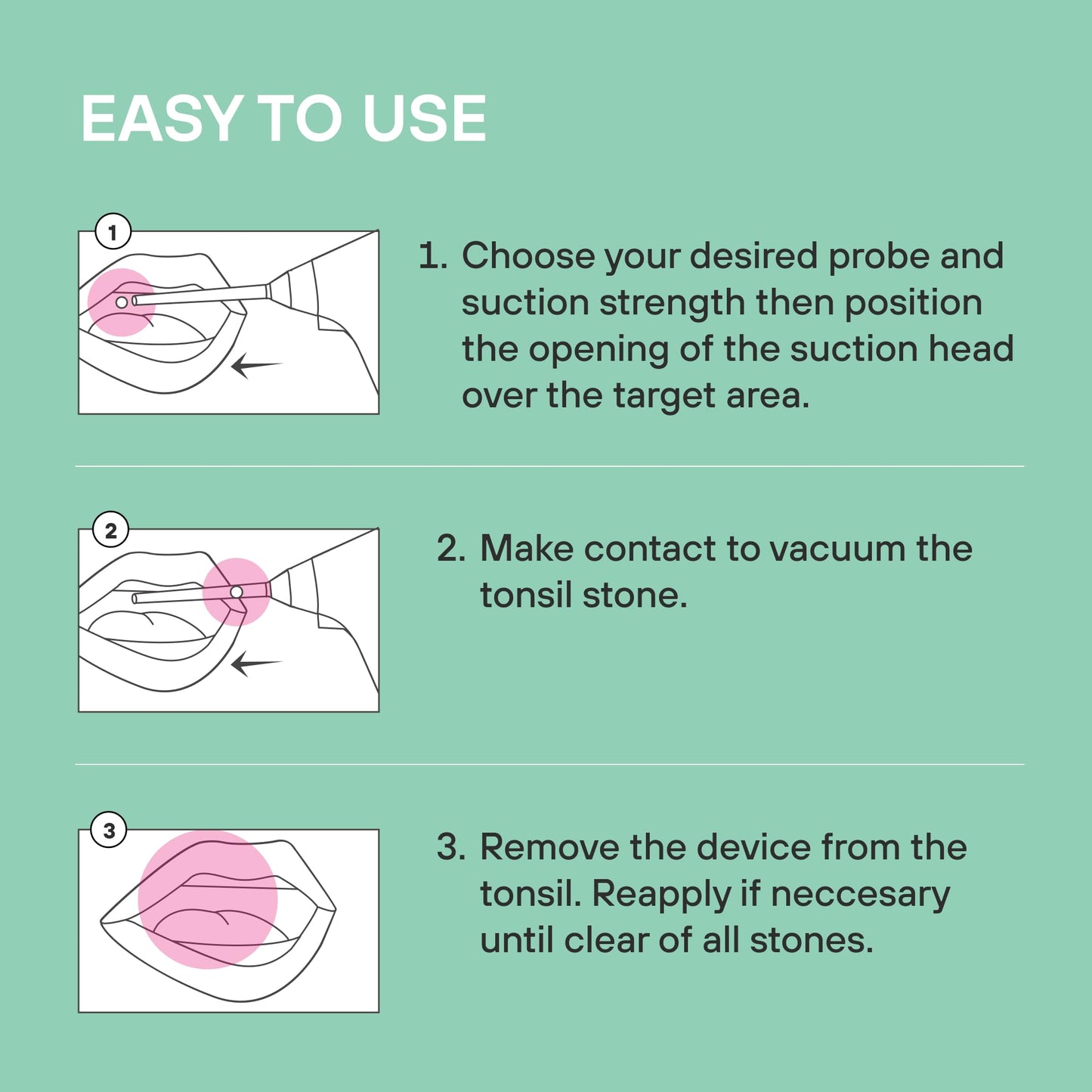 Electronic Vacuum Tonsil Stone Remover with LED Guidance Light - Hassle-Free Instant Suction - Tonsil Stone Removal Kit - Patent Pending (White)