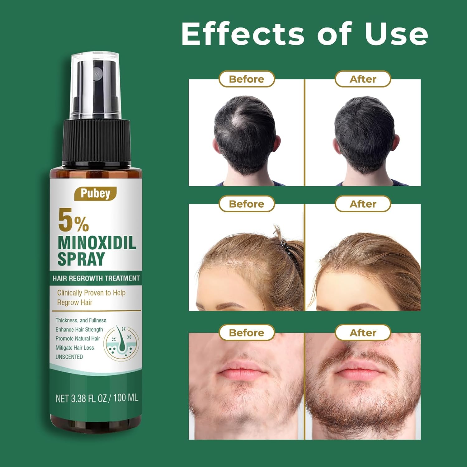 5% Minoxidil Hair Growth Spray for Men & Women - Beard & Scalp Regrowth Serum, 3.38 Fl Oz
