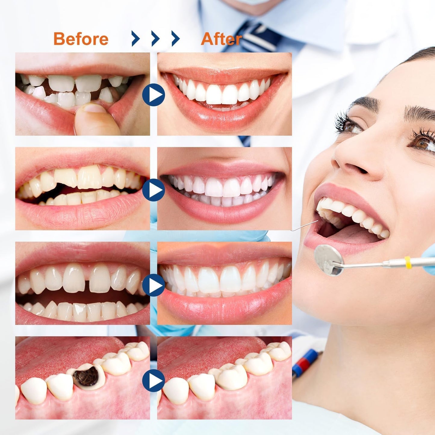 Tooth Repair Kit, Moldable Tooth Filling Repair Kit with 4 Dental Tool, Dental Care Kit Fixing The Missing and Broken Replacements, DIY Natural Filling Fake Teeth,Smile Confidently Again-8A