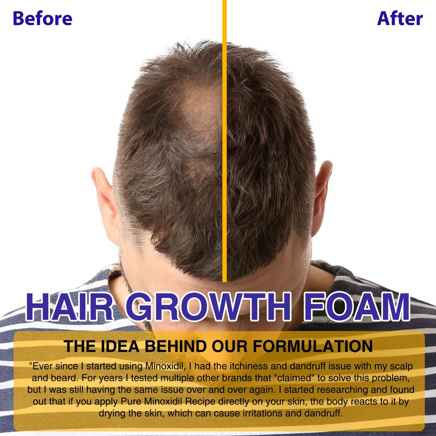 5% Minoxidil Foam for Hair Growth and Thickening - Biotin & Minoxidil Treatment to Stop Thinning & Hair Loss for Men & Women, 2oz