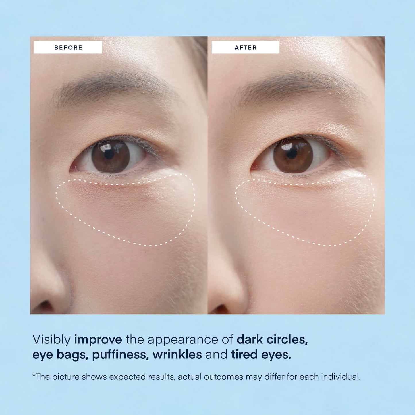 Under Eye Patches for Dark Circles: Puffiness & Eye Bag Treatment Gel Mask with Caffeine Hyaluronic Acid Niacinamide - Undereye Brightening Hydrating Anti-Wrinkle & Cooling - Korean Skincare, 30 Pairs