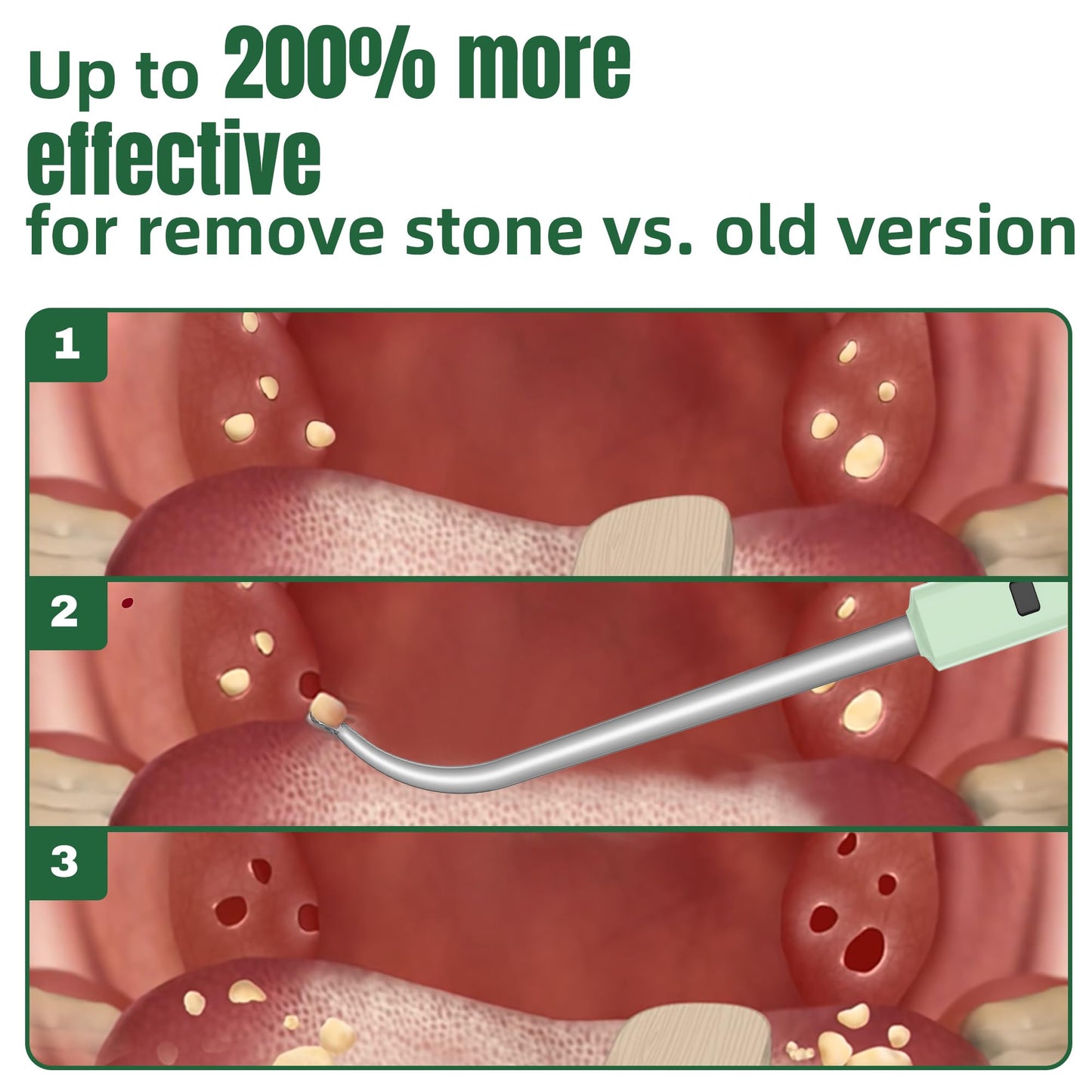 EVNRH 2025 Best Tonsil Stone Remover 6pcs Extended LED Light Guiding Scoop Curved Tonsil Stone Removal Kit Remove Tonsil Stone Water Flosser Oral Irrigator Tool Rinse Syringe Cleaner Fresh Breath Soft