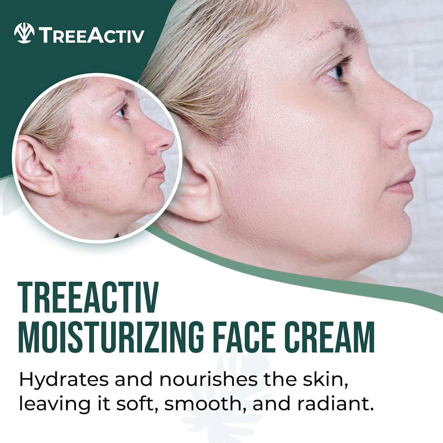 TreeActiv Acne Face Cream - Natural Extra Strength Treatment for Clear Skin | Fast-Acting, Gentle for All Skin Types | 2 fl oz