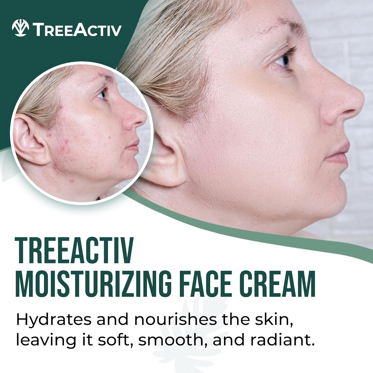 TreeActiv Acne Face Cream - Natural Extra Strength Treatment for Clear Skin | Fast-Acting, Gentle for All Skin Types | 2 fl oz