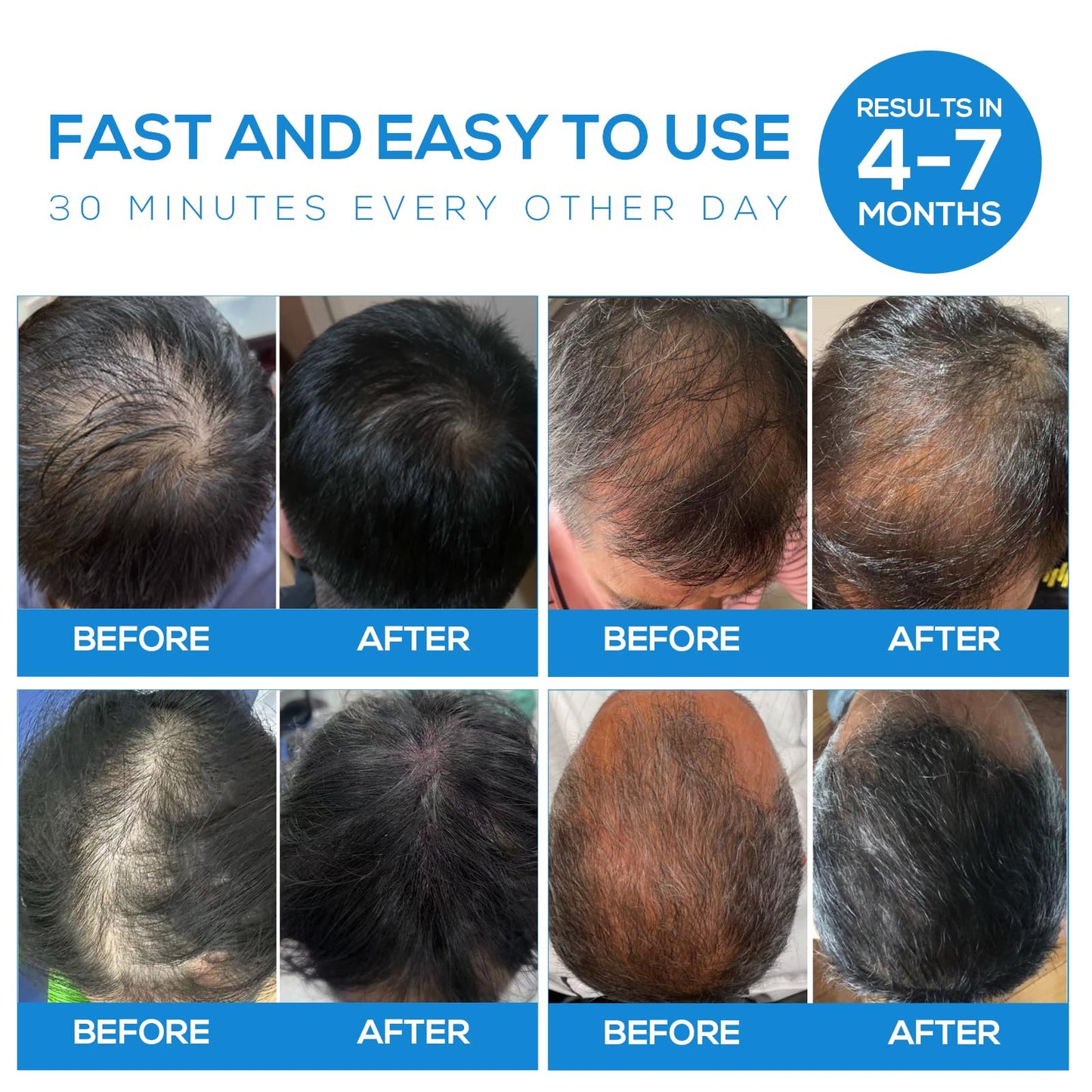 Tkcsoi Laser Hair Growth Cap,Laser Hair Growth Cap is Low Level Laser Therapy (LLLT) Devices That Promote Hair Growth in Women and Men