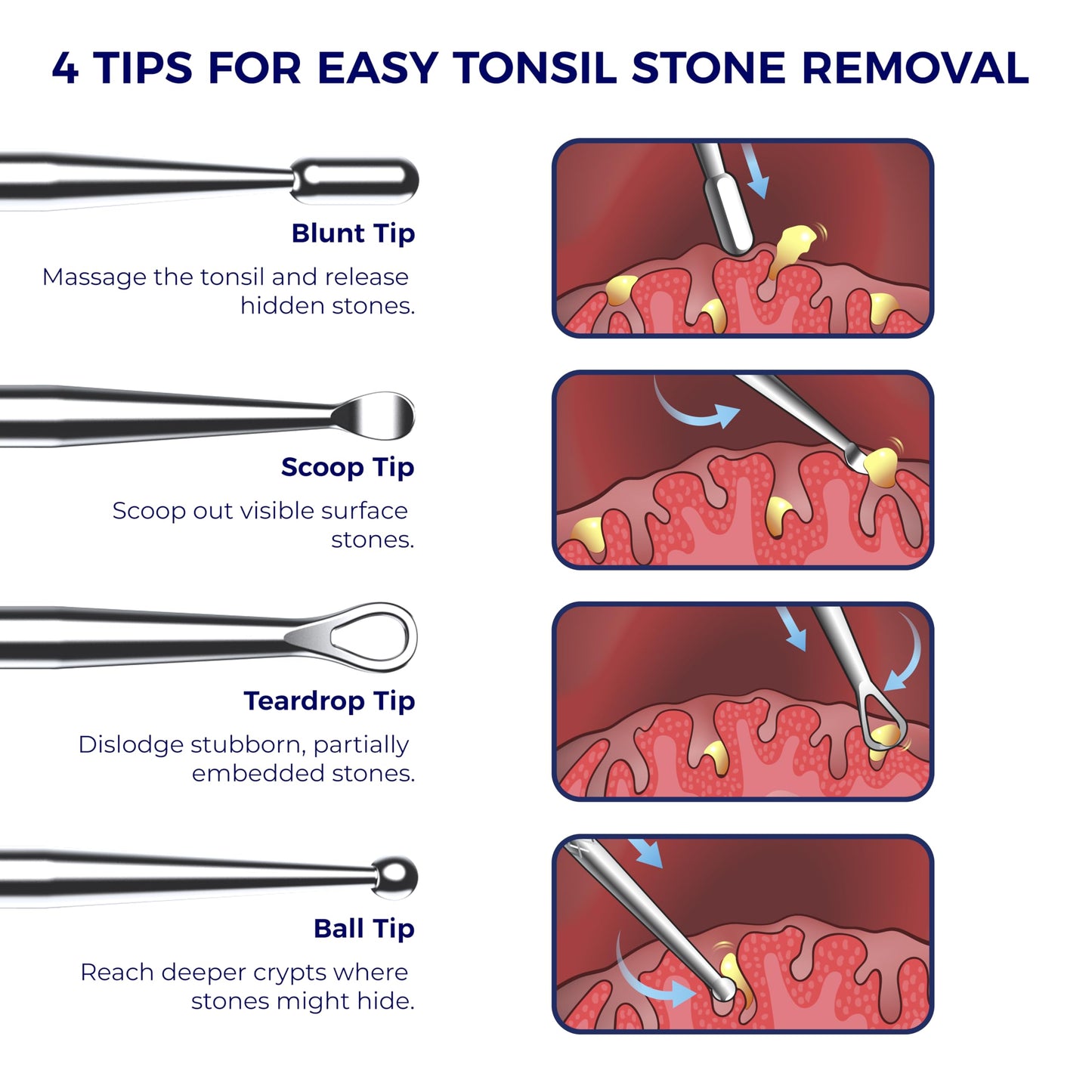 Oravix Tonsil Stone Remover Tool Pack of 2, Metal Tonsil Stone Removal Tool, 7’’ Surgical-Grade Stainless Steel Metal Pick with 10 Soft Silicone Tips, Fight Bad Breath, Safe & Easy