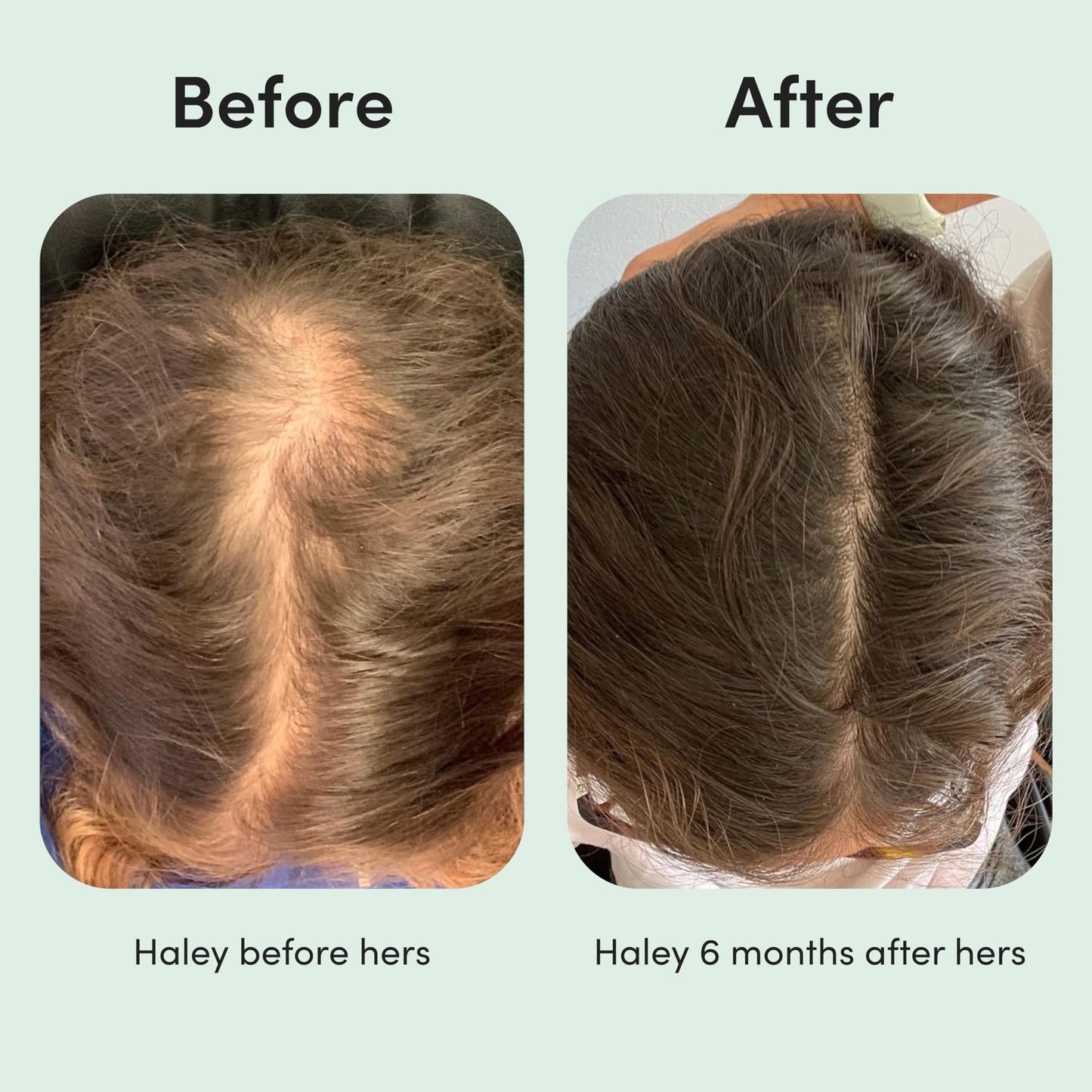 hers Topical Minoxidil Solution, 2% - Hair Growth Treatment for Women - Clinically Proven to Reduce Hair Loss in 3-6 Months - Unscented, 2 Pack