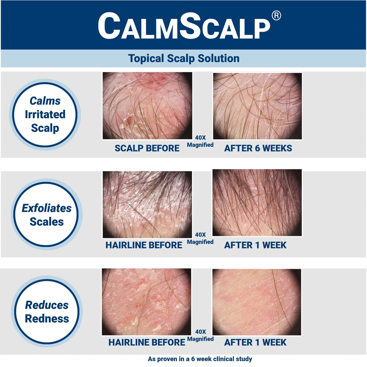 CalmScalp Scalp Solution | Calms Irritated, Itchy Scalp and Scalp Psoriasis | Dry Scalp Treatment | Reduces Scales, Flakes & Redness | Clinically Proven | Start Seeing Results in 1 week | 4 oz