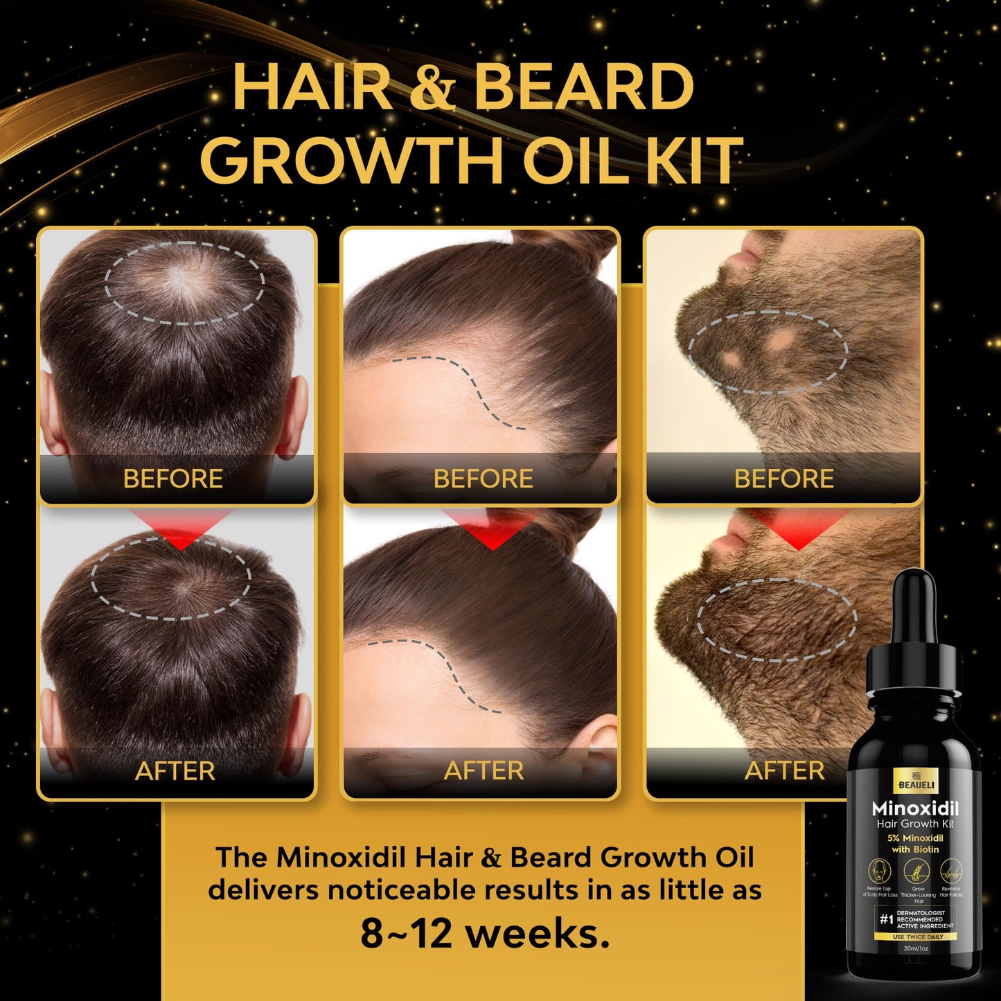 beaueli Minoxidil for Men Beard Growth Kit, Minoxidil for Women Hair Growth Kit, Hair Loss Treatments for Women Hair Regrowth Treatment, Minoxidil 5%, Black