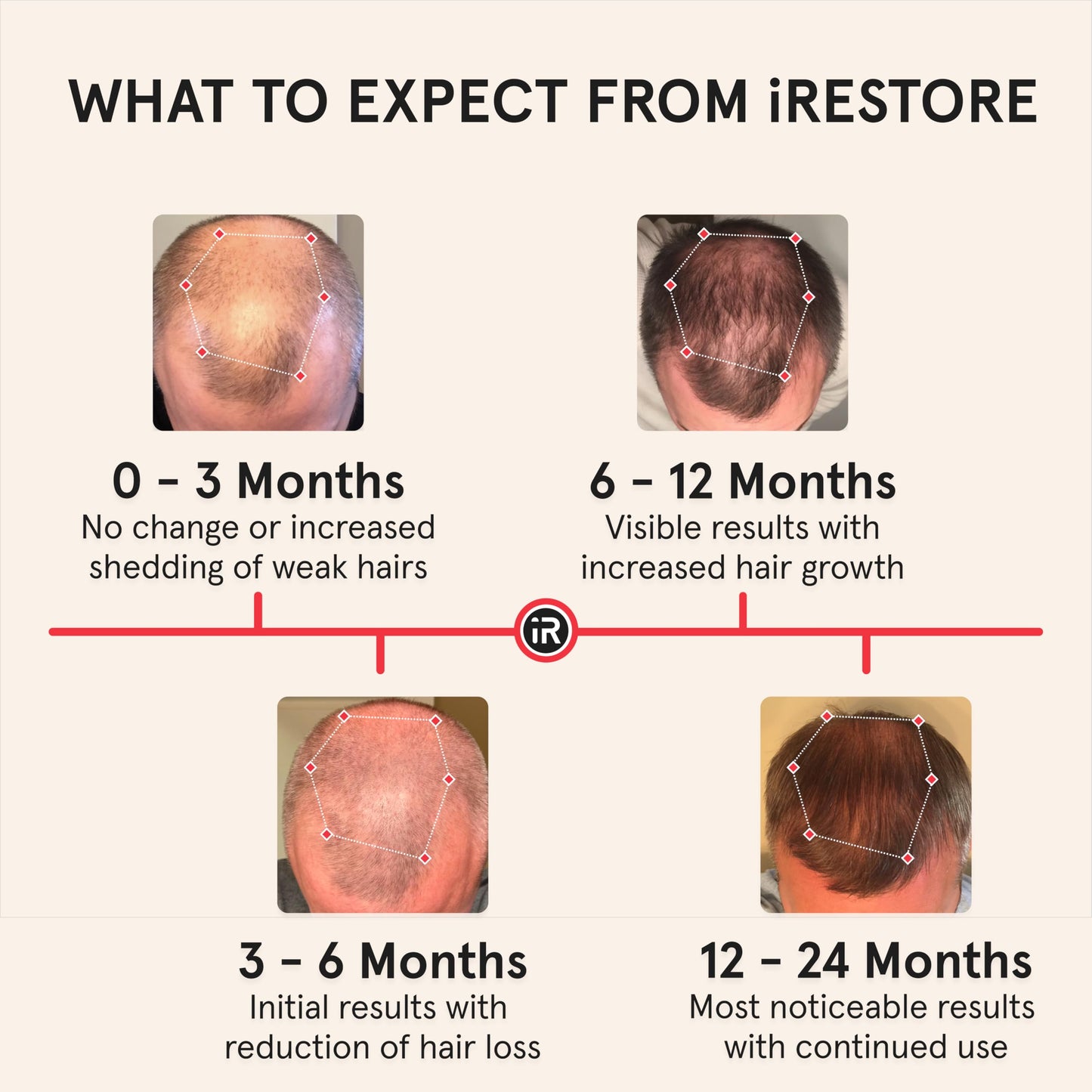 iRestore Professional Laser Red Light Therapy for Hair Growth System - FDA Cleared Hair Loss, Hair Thinning & Alopecia Treatment for Men & Women - 282 Lasers & LEDs