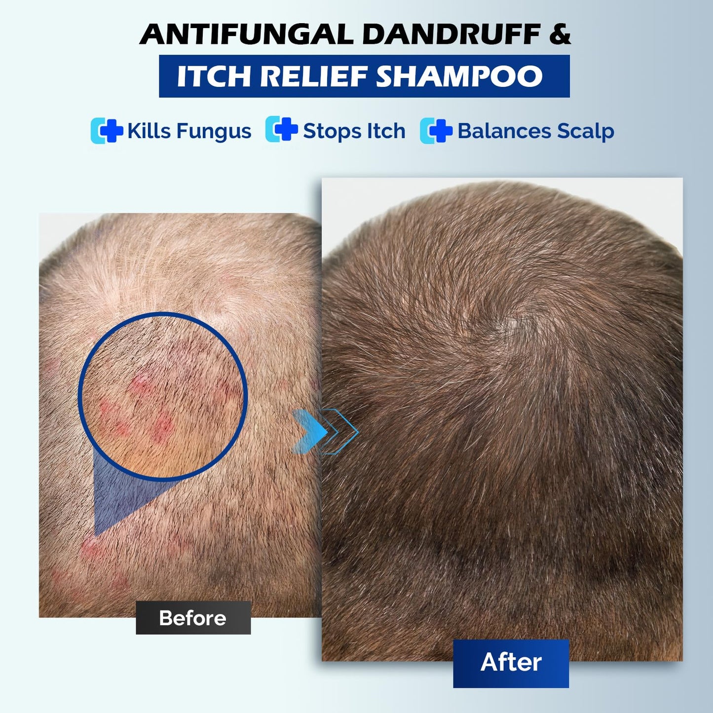 Antifungal Shampoo for Seborrheic Dermatitis, Folliculitis & Scalp Psoriasis, Anti-Dandruff Shampoo for Men & Women, Relieves Scalp Itching, Dryness, Sulfate & Paraben-Free, 10.1 Fl Oz