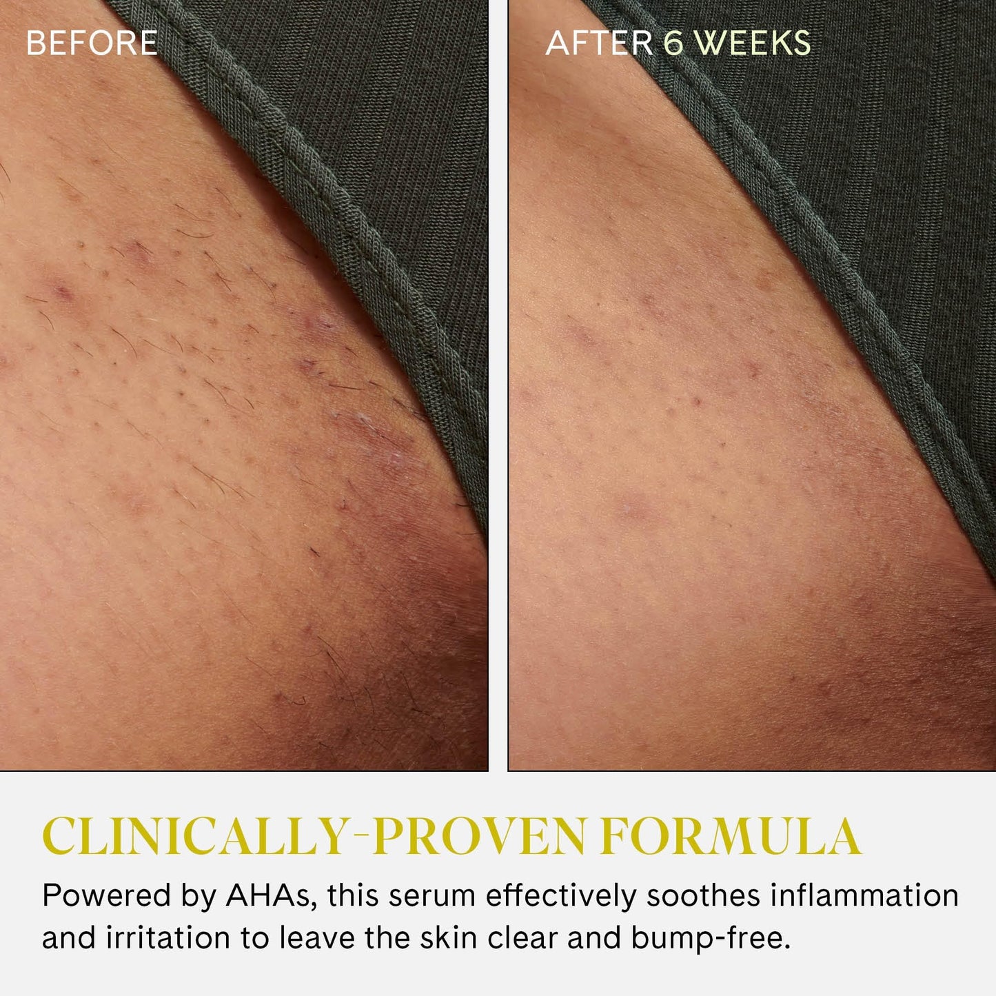 Fur Ingrown Eliminator Serum Rollerball Travel Size - Powerful Ingrown Hair Treatment Serum With AHAs and BHAs to Treat Ingrown Hairs and Bumps, Hydrates and Soothes Irritated Skin - 10 ml