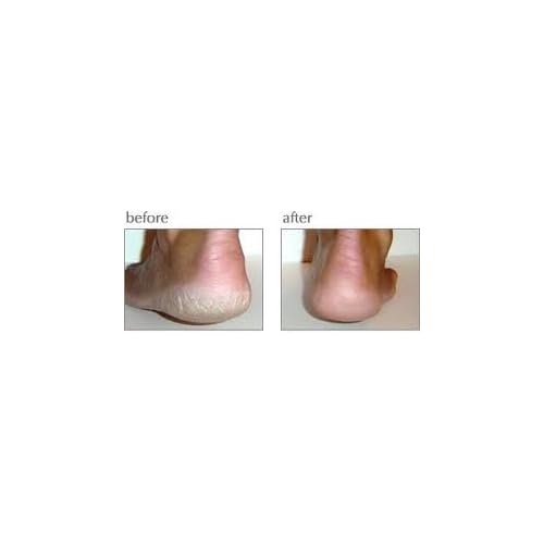 Luxuriant Cracked Heel Repair The ORIGINAL Twin Pack 2.5oz Dry Cracked Chapped Heels Feet Elbows Knees Skin