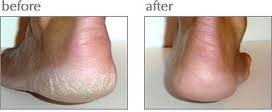 Luxuriant Cracked Heel Repair Stick Twin Pack - Made in USA, 2.3 oz Each (Variation 2)