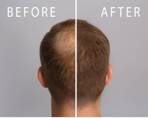 Mane Rain Z-LAB27 BioActive Plant Hair Growth Treatment for Men & Women