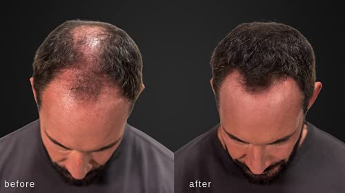 Hair Building Fibers for Thinning Hair - Natural Thickening - Dark Brown - 2 Months+ Supply