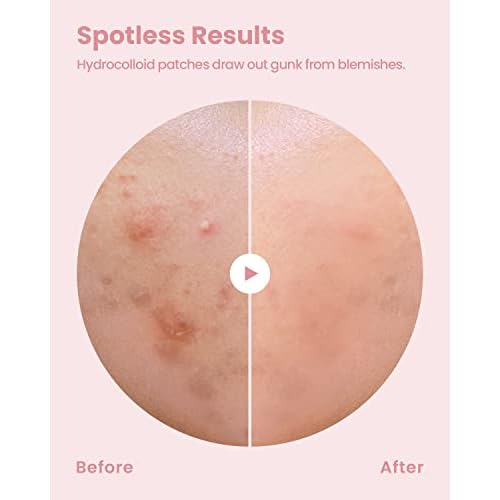 GLAM UP Hydrocolloid Blemish Pimple Zit Patches(180PCS/2Size) - Invisible Ultra Thin Spot Cover Stickers for Face and Skin, Strong Water-proof and Adhesive Overnight, Vegan-friendly