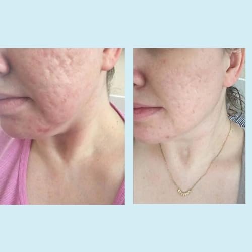 Professional 70% Glycolic Gel Peel with Retinol & Green Tea Extract - For Experienced Users
