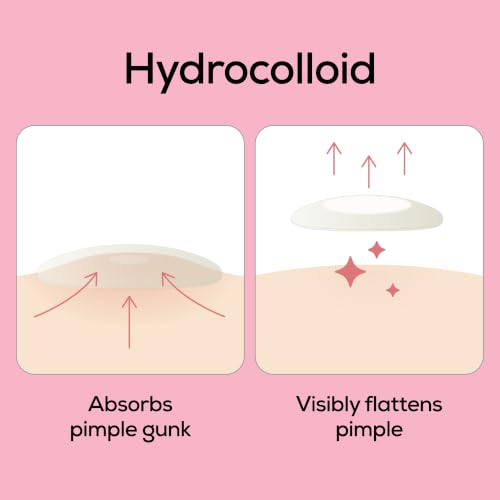 Hydrocolloid Acne Patches Set - 288 Count, Clear Surface Blemish Cover