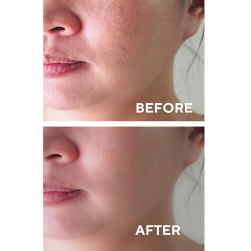 The Ceel Facial Peeling Serum With 10% AHA 2% BHA, Saliscylic Acid Serum for Blemishes, Chemical Peel at Home, Glycolic Acid Peel With Hyaluronic Acid,AHA and BHA, 1.00 fl.oz (30 ml)