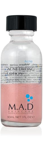Acne Spot Treatment - 10% Sulfur & Salicylic Acid, Drying Lotion, 1 Fl Oz - Pack of 1