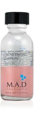 Acne Spot Treatment - 10% Sulfur & Salicylic Acid, Drying Lotion, 1 Fl Oz - Pack of 1