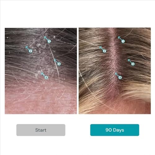 Dandruff Shampoo & Conditioner Set for Scalp Care - 205 mL