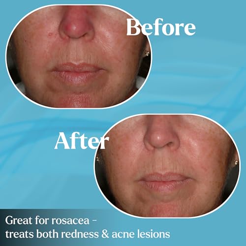 Anti-Aging & Rosacea Skin Cream with Cytokinin - Reduces Redness, Fine Lines & Hyperpigmentation - 2 oz