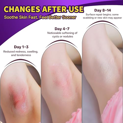 Hidradenitis Suppurativa | Fast Relief for HS Flares, Cysts, Infections, Razor Bumps, Abscesses | Natural Hidradenitis Suppurativa Cream with Propolis, Beeswax & Essential Oils ? 4 oz