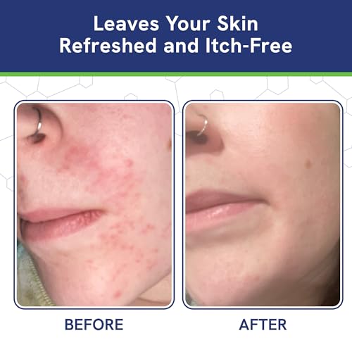 pHat 5.5 Itch Cream for Itchy Skin Relief - Moisturizing Cream & Face Lotion for Women - Redness Relief for Face & Body - For Dry Skin & Itchy Scalp - Anti Itch Lotion (4oz)