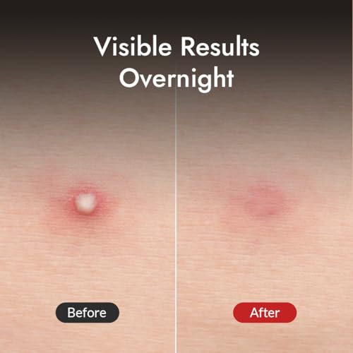 MIZON Good Bye Blemish Clear Patch Invisible Korean Acne Pimple Covering Zits Waterproof Non-drying Thin Cover Excellent Skin Adhesion Patch Spot Cover (44ea)