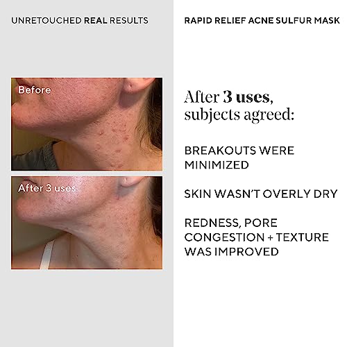 Murad Rapid Relief Acne Sulfur Mask ? Clay Mask with Salicylic Acid, 5% Sulfur, and Austrian Peat Reduces Oil, Minimizes Breakouts, Reduces Pimple Size, and Unclogs Pores ? 2.5 Fl Oz