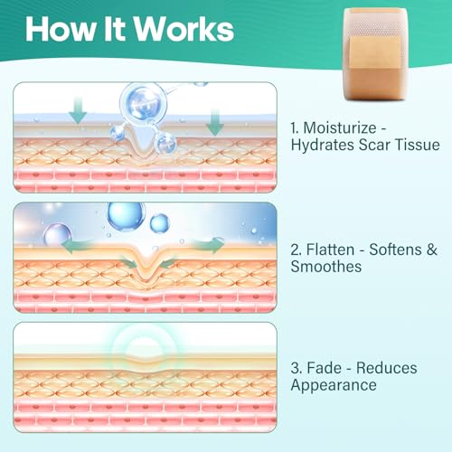 Silicone Gel Patch, Scar Removal Tape for C-Section£¬Surgical£¬Tummy Tuck£¬Burn, Acne, Keloid Bump Removal(1.6"X 120" Roll-3M) Surgery Recovery Items£¬Reusable Scar Away Silicone Sheets