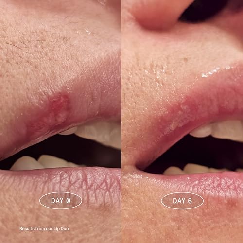 Lip Balm for Cold Sore & Dry Lips - Hydrating Moisturizer 0.17 oz - Variation of THIS listing