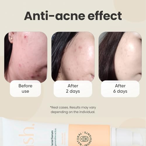 NSH Aloe & Hyaluronic Acid Face Serum 3.38 Fl oz ? Ultra Hydrating, Anti-Aging & Anti-Acne Formula with Aloe, HA, Collagen, Elastin, Vitamin B5 & Vitamin E for Plumper, Clearer, Rejuvenated Skin