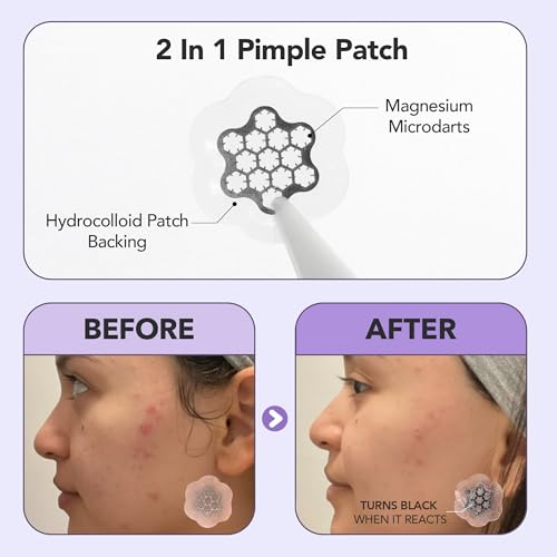 Magnesium Blemish Microdarts | Pimple Patch | Fast-Acting | Quick Calming | 99.9% Pure Magnesium | Madecassic Acid | Tea Tree | Eucalyptus Leaf | Hydrocolloid Spot Care Patch (Large 6 Patches)