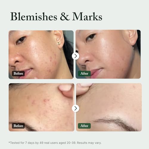 Azelaic Acid 10% Serum for Uneven Skin Tone & Blemish Marks - 1 fl oz