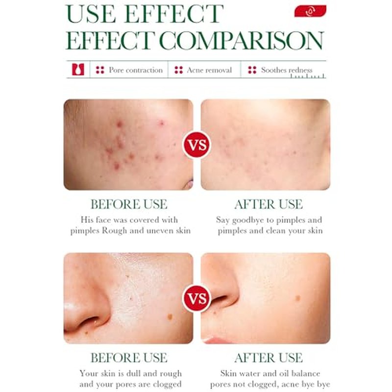 BIOAQUA Salicylic Acid Acne Removal Essence Shrinks Pores Soothing Redness Fade Acne Marks 35ml / 1.23fl.oz