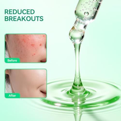 Tea Tree Acne Treatment Serum, Clear Skin Serum for Clearing Severe Acne,Breakout, Remover Pimple and Repair Skin (20ml,0.67oz)