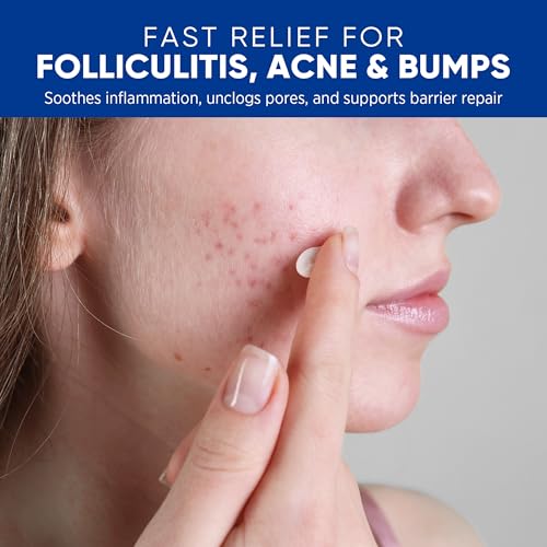 AOSORW Folliculitis & Acne Treatment Cream with Salicylic Acid & Herbal Extracts - 100g for Face, Body & Scalp