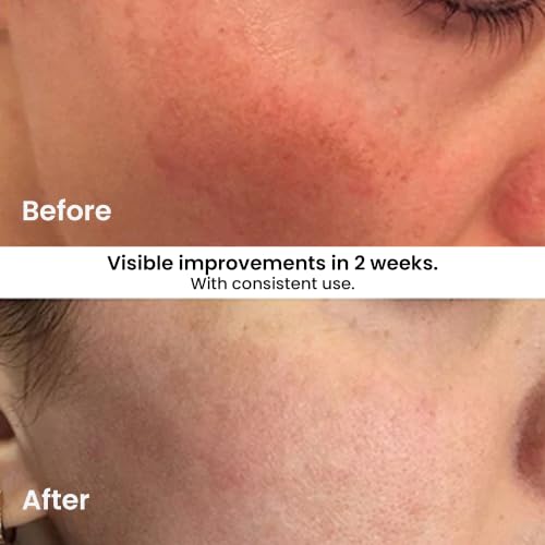 KLEEM Vitamin C Serum for Face 1.7 Fl Oz - Brightening & Anti-Aging