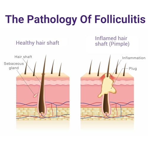 Folliculitis Treatment Cream - Natural Relief for Itching Redness & Inflammation - 3.53 Oz - Variation 1