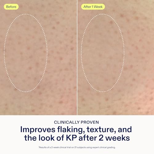 KP & Psoriasis Body Treatment with Lactic Acid - Smoothing Moisturizer 5.07 oz
