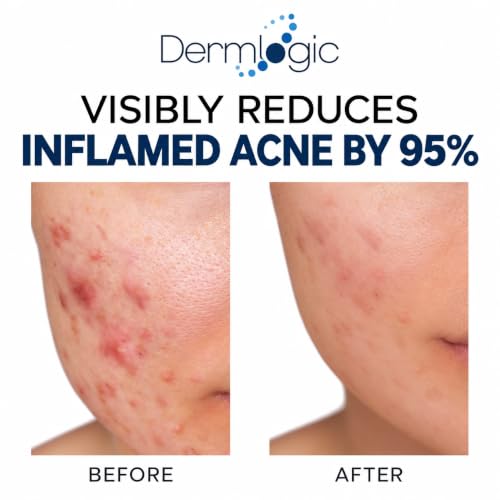 Acne Treatment Pads with Glycolic Lactic Salicylic Acid for Face & Body