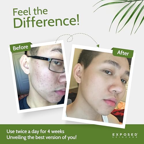 Oil-Free Hydrating Face Moisturizer for Acne-Prone Skin - Brighten & Nourish
